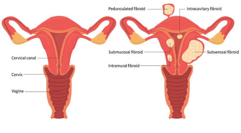 fibroid causes, fibroids symptoms